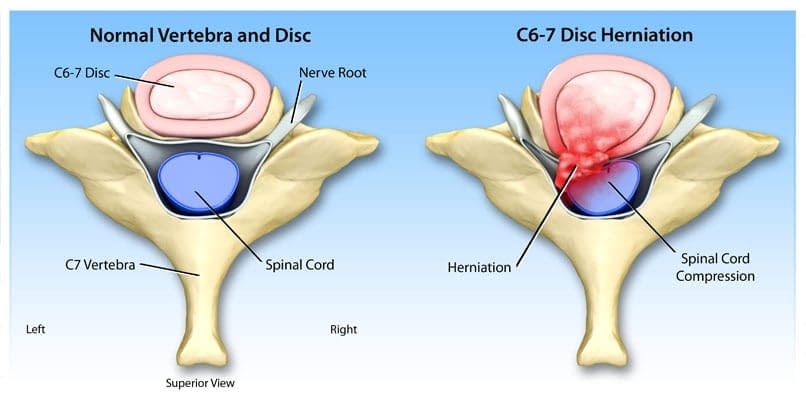 Herniated Disc Injury Settlements With Steroid Injections