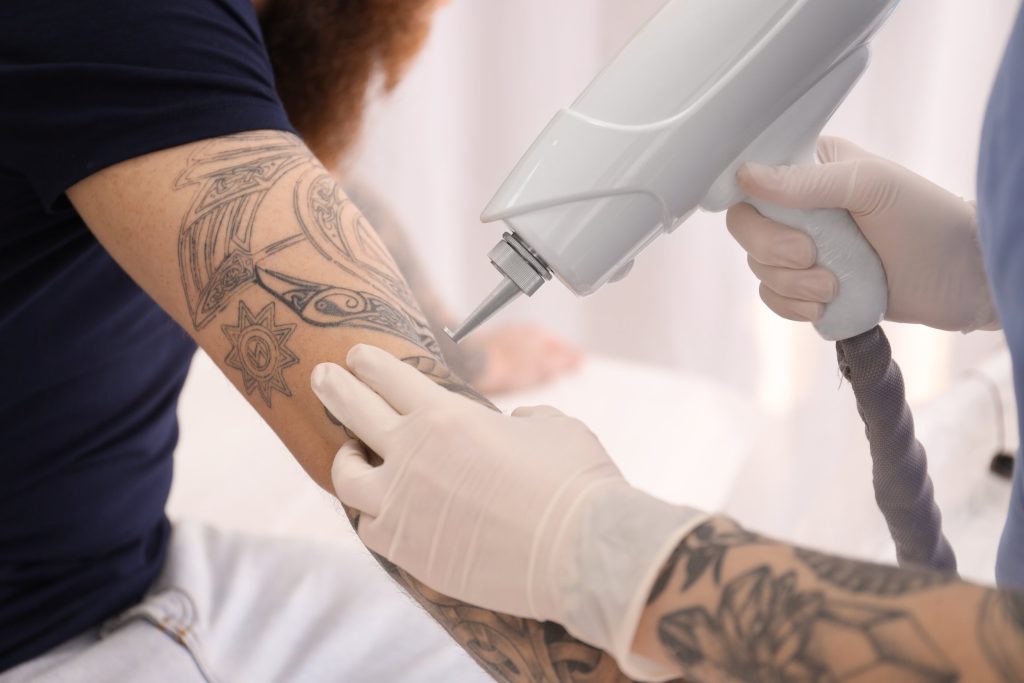 How Long Does Tattoo Removal Take